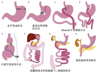 减肥手术医保能不能报销_手术减肥_减肥手术多少多钱