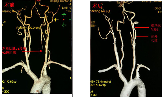 椎动脉变异图片