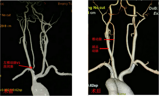 椎动脉变异图片