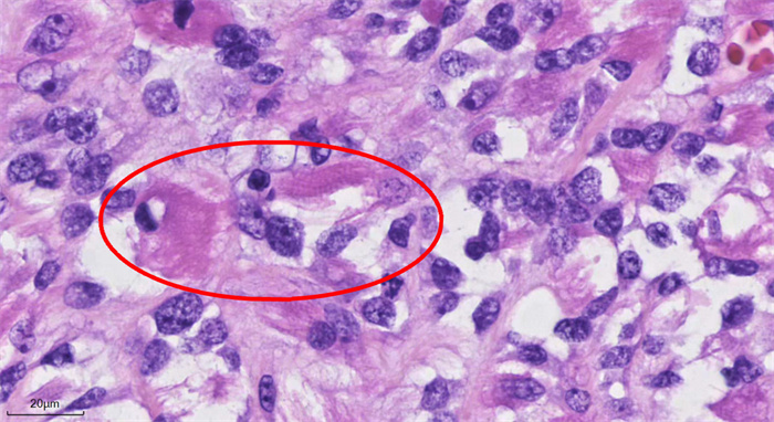抽丝剥茧 破解巨大肿瘤快速复发的谜团——北京天坛医院成功诊断全球报告不足百例的罕见肿瘤